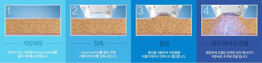 미쿨 시술 과정. 1.지방세포=원하지 않는 지방층에 Smart Gel Pad를 붙여 피부를 보호합니다. 2.접촉=Smart Gel Pad를 붙인 곳에 어플리케이터를 접촉시킵니다. 3.음압=읍압을 이용하여 지방층을 어플리케이터 안쪽으로 흡입합니다. 4.냉각 에너지 전달=정밀하게 조절된 강력한 냉각 에너지가 지방세포 조직에 전달됩니다.