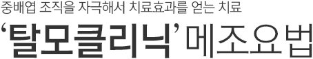 중배엽 조직을 자극해서 치료효과를 얻는 치료. 탈모클리닉. 메조요법.