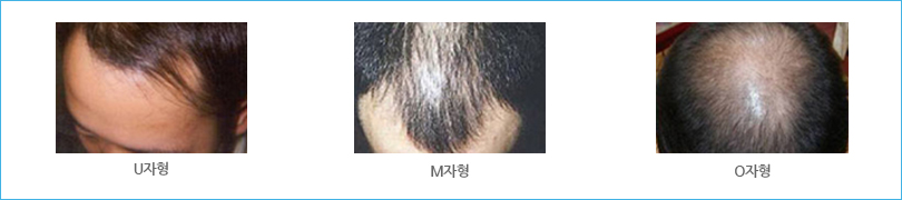 남성 유전형 탈모 U자형,M자형,O자형 탈모 환자 사진.