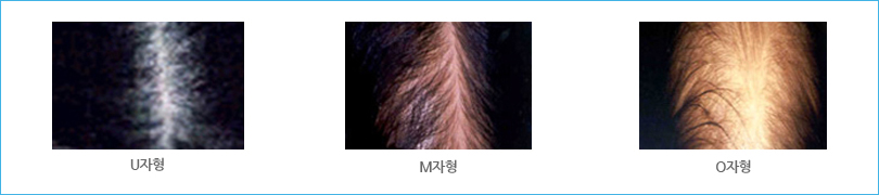 여성,산후 탈모 U자형,M자형,O자형 탈모 환자 사진.