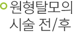 원형탈모의 시술 전/후