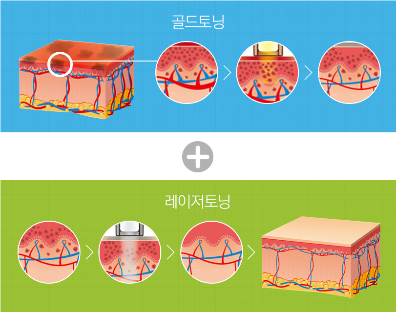 골드토닝 + 레이저토닝 관련 그림이미지