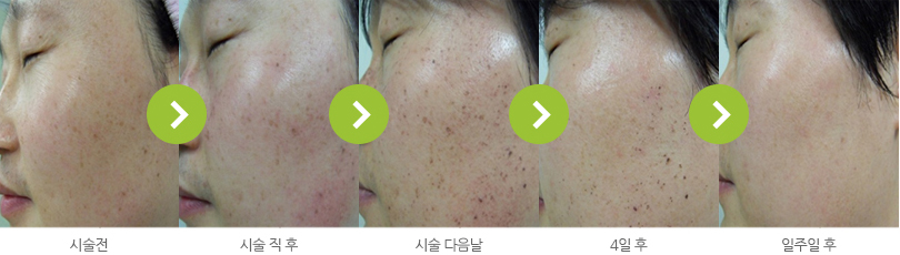 옅은 색소 시술 과정 사진