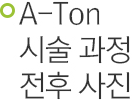 A-Ton 시술 과정 전후 사진