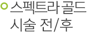 스펙트라골드 시술 전후