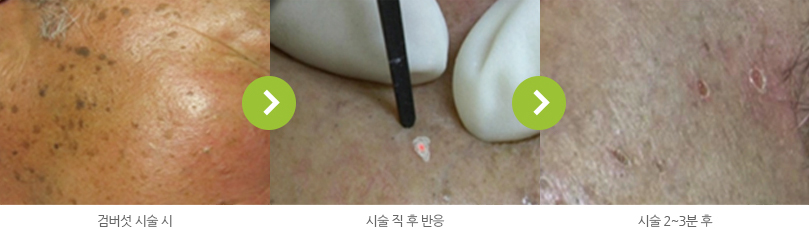 검버섯 시술 전후 사진