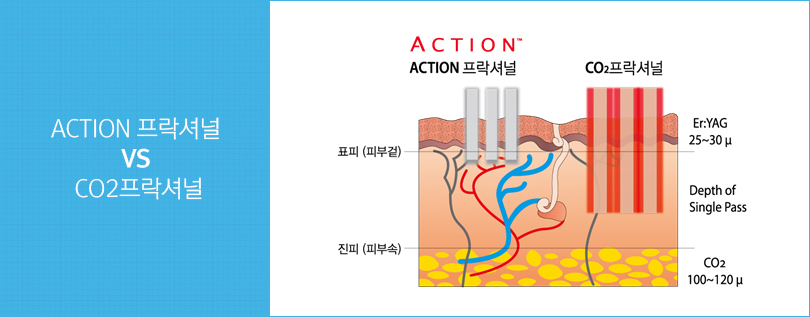 Action 프락셔널과 CO2프락셔널 비교그림. Co2프락셔널에 비해 ACTION 프락셔널은 진피 자극이 덜함을 보여줌