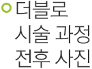 더블로 시술 과정 전후 사진