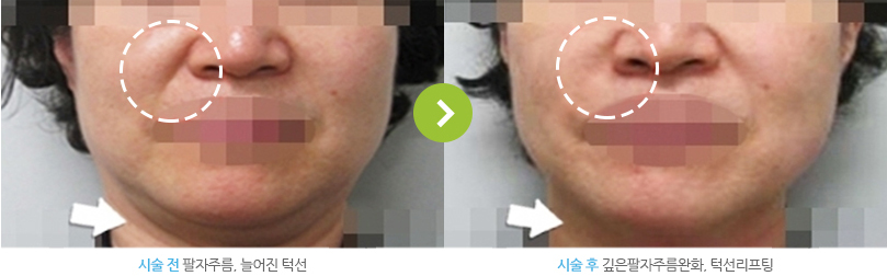 시술 전 팔자주름,늘어진 턱선. 시술 후 깊은 팔자주름완화,턱선리프팅