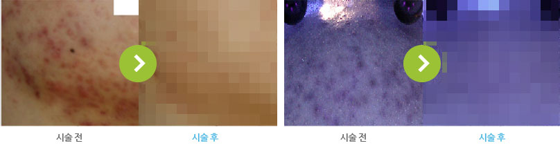 인피니 시술 전/후 사진