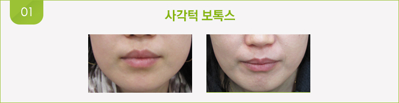 사각턱 보톡스 전후 사진