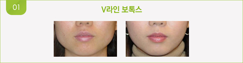 V라인 보톡스 전후 사진