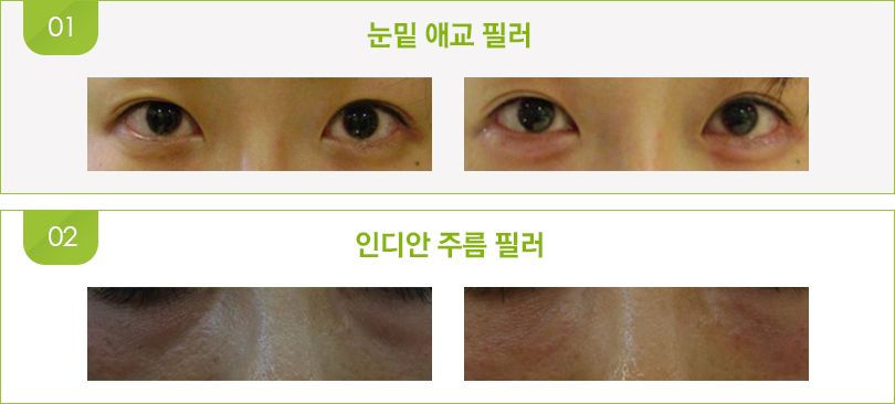 눈밑 애교 필러, 인디안 주름 필러 전후사진