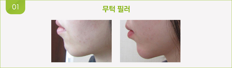 무턱 필러 전후사진