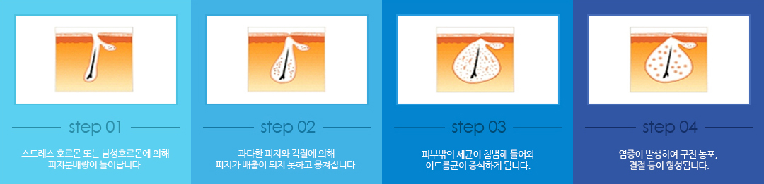 시술 진행과정. 1.스트레스 호르몬 또는 남성호르몬에 의해 피지분배량이 늘어납니다. 2.과다한 피지와 각질에 의해 피지가 배출이 되지 못하고 뭉쳐집니다. 3.피부밖의 세균이 침범해 들어와 여드름균이 증식하게 됩니다. 4.염증이 발생하여 구진 농포,결절 등이 형성됩니다.