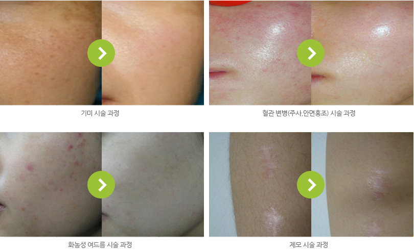 기미 시술 전후, 혈관 변병(주사,안면홍조) 시술 전후. 화농성 여드름 시술 전후. 제모 시술 전후 사진
