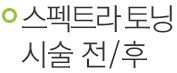 스펙트라 시술 전/후