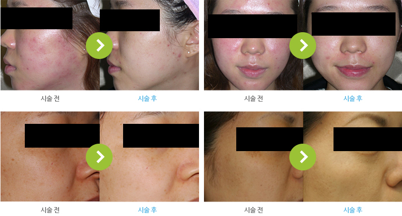 스펙트라 시술 전/후 사진