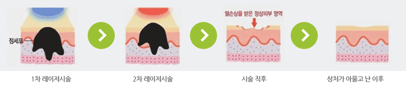 시술과정 그림
