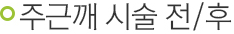 주근깨 시술 전/후