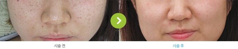주근깨 시술 전/후 사진