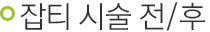 잡티 시술 전/후