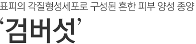 표피의 각질형성세포로 구성된 흔한 피부 양성 종양. 검버섯.