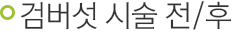 검버섯 시술 전/후