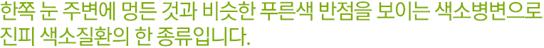 한쪽 눈 주변에 멍든 것과 비슷한 푸른색 반점을 보이는 색소병변으로 진피 색소질환의 한 종류입니다.