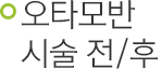 오타모반 시술 전/후