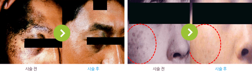 오타모반 시술 전/후 사진
