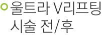 울트라V리프팅 시술 전/후