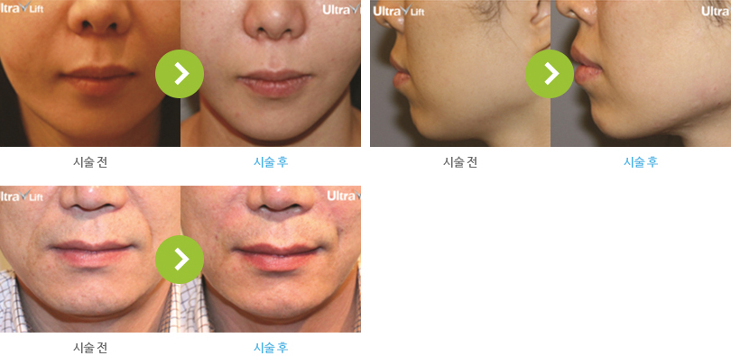 울트라V리프팅 시술 전후 사진