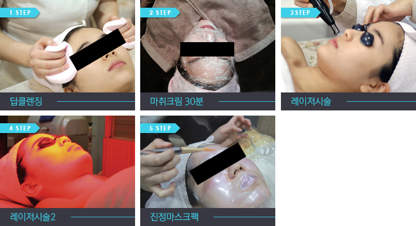 레이저 시술과정 사진
