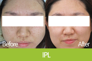 IPL 시술 전후