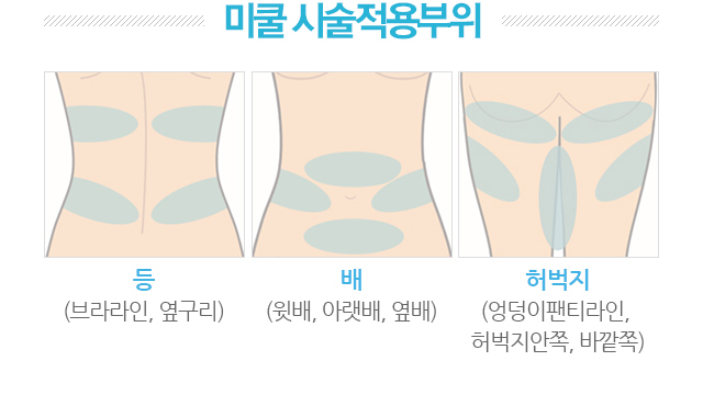미쿨 시술적용부위. 1.등(브라라인,옆구리). 2.배(윗배,아랫배,옆배). 3.허벅지(엉덩이팬티라인,허벅지안쪽,바깥쪽)