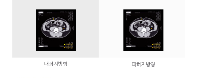 내장지방형 CT사진과 피하지방형 CT사진.