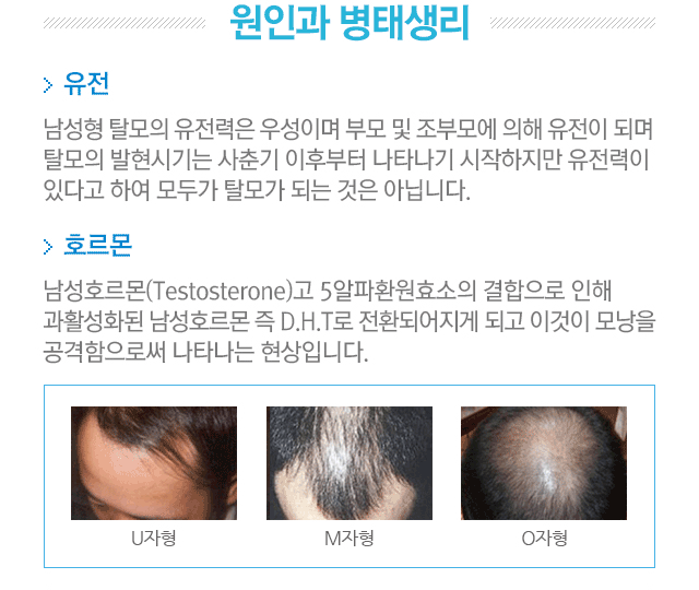 원인과 병태생리. 유전. 남성형 탈모의 유전력은 우성이며 부모 및 조부모에 의해 유전이 되며 탈모의 발현시기는 사춘기 이후부터 나타나기 시작하지만 유전력이 있다고 하여 모두가 탈모가 되는 것은 아닙니다. 호르몬. 남성호르몬(Testosterone)고 5알파환원효소의 결합으로 인해 과활성화된 남성호르몬 즉 D.H.T로 전환되어지게 되고 이것이 모낭을 공격함으로써 나타나는 현상입니다. U자,M자,O자 탈모 사진.