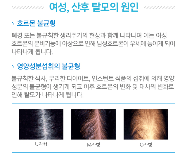 원인과 병태생리. 1.호르몬 불균형. 폐경 또는 불규칙한 생리주기의 현상과 함께 나타나며 이는 여성 호르몬의 분비기능에 이상으로 인해 남성호르몬이 우세에 놓이게 되어 나타나게 됩니다. 2.영양성분섭취의 불균형. 불규칙한 식사, 무리한 다이어트,인스턴트 식품의 섭취에 의해 영양성분의 불균형이 생기게 되고 이후 호르몬의 변화 및 대사의 변화로 인해 탈모가 나타나게 됩니다. U자형,M자형,O자형 탈모증세 사진.