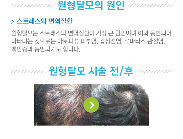 원형탈모의 원인. 스트레스와 면역질환. 원형탈모는 스트레스와 면역질환이 가장 큰 원인이며 이와 동반되어 나타나는 것으로는 아토피성 피부염,갑상선염,류마티스 관절염,백반증과 동반되기도 합니다. 원형탈모 치료 전/후 사진.