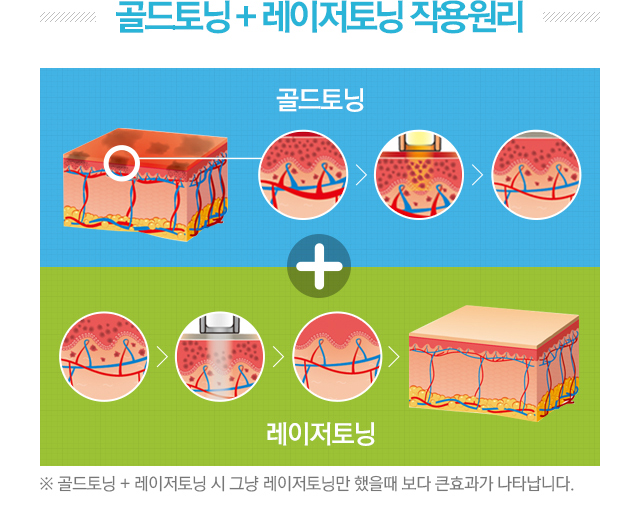 골드토닝+레이저토닝 작용원리. 골드토닝+레이저토닝 시 그냥 레이저토닝만 했을때보다 큰 효과가 나타납니다.
