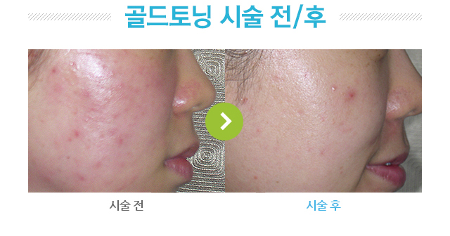 골드토닝 시술 전/후 사진.