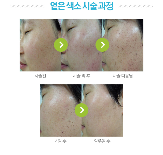 옅은 색소 시술 전후 사진.