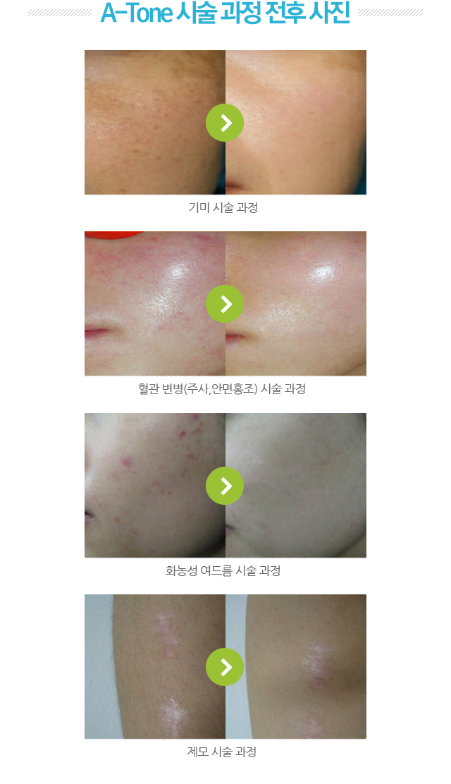 A-Tone 시술 과정 전후 사진.