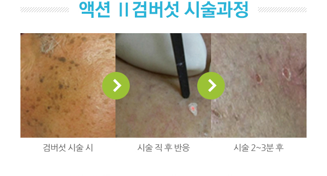 액션2 검버섯 시술과정 사진.