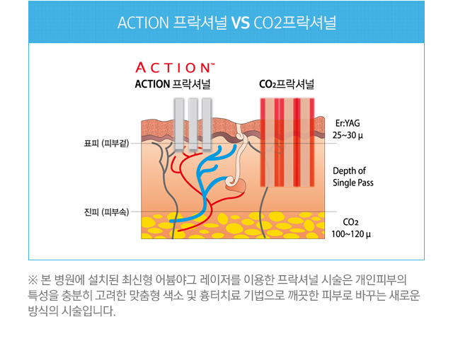 Action프락셔널 VS CO2프락셔널. Action프락셔널이 Co2프락셔널에 비해 진피의 자극이 덜하고 효과적으로 피부개선을 이루어낼 수 있음을 보여주는 그림. 본 병원에 설치된 최신형 어븀야그 레이저를 이용한 프락셔널 시술은 개인피부의 특성을 충분히 고려한 맞춤형 색소 및 흉터치료 기법으로 깨끗한 피부로 바꾸는 새로운 방식의 시술입니다.