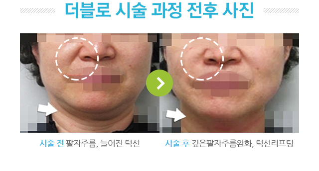 더블로 시술 과정 전후 사진. 시술 후 깊은팔자주름 완화,턱선리프팅.