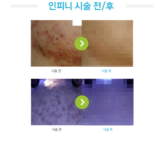 인피니 시술 전후 사진.