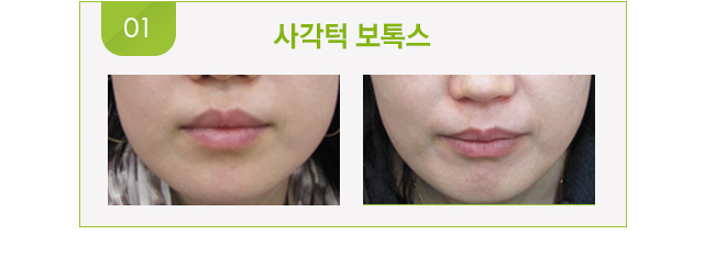 사각턱 보톡스 시술 전후 사진.