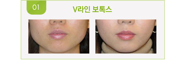 V라인 보톡스 시술 전후 사진.